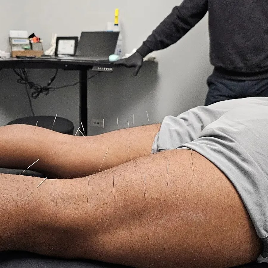 Dry needling through the quad and thigh